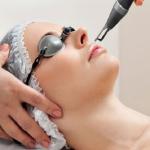 Bắn trẻ hóa CO2 toàn mặt